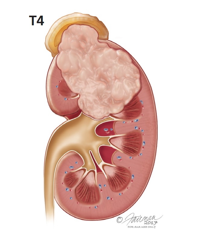 Kidney Tumor Size Chart
