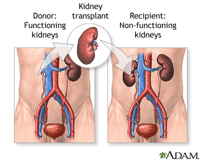 kidney transplant ile ilgili gÃ¶rsel sonucu