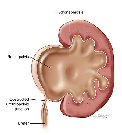 Anatomy of Ureteropelvic Junction Obstruction (UPJ)