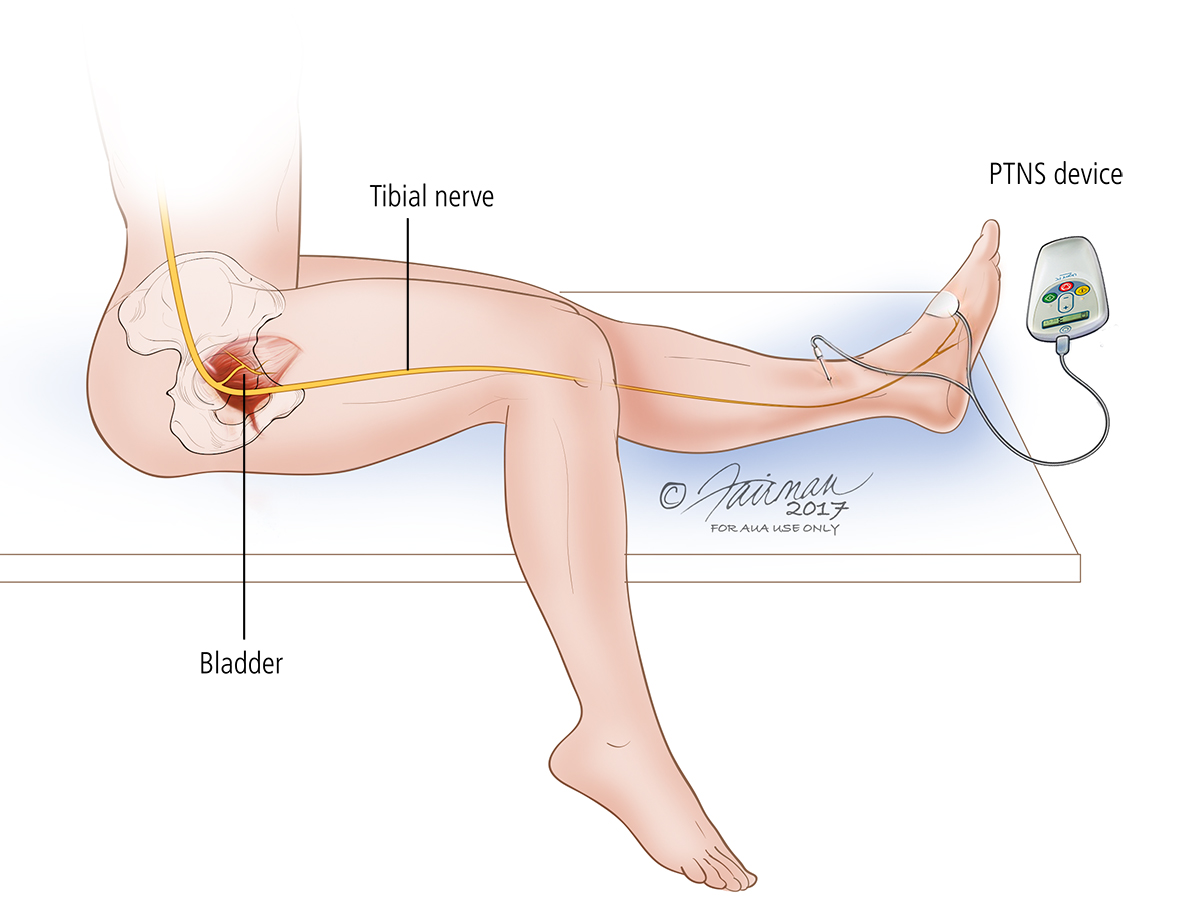 Electrical stimulation for overactive bladder (OAB)