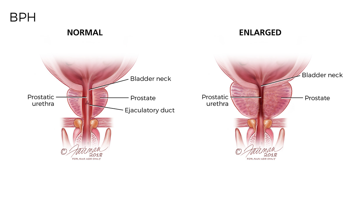 treatment enlarged prostate gland