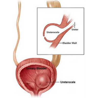 Ureterocele: Symptoms, Diagnosis & Treatment - Urology Care Foundation