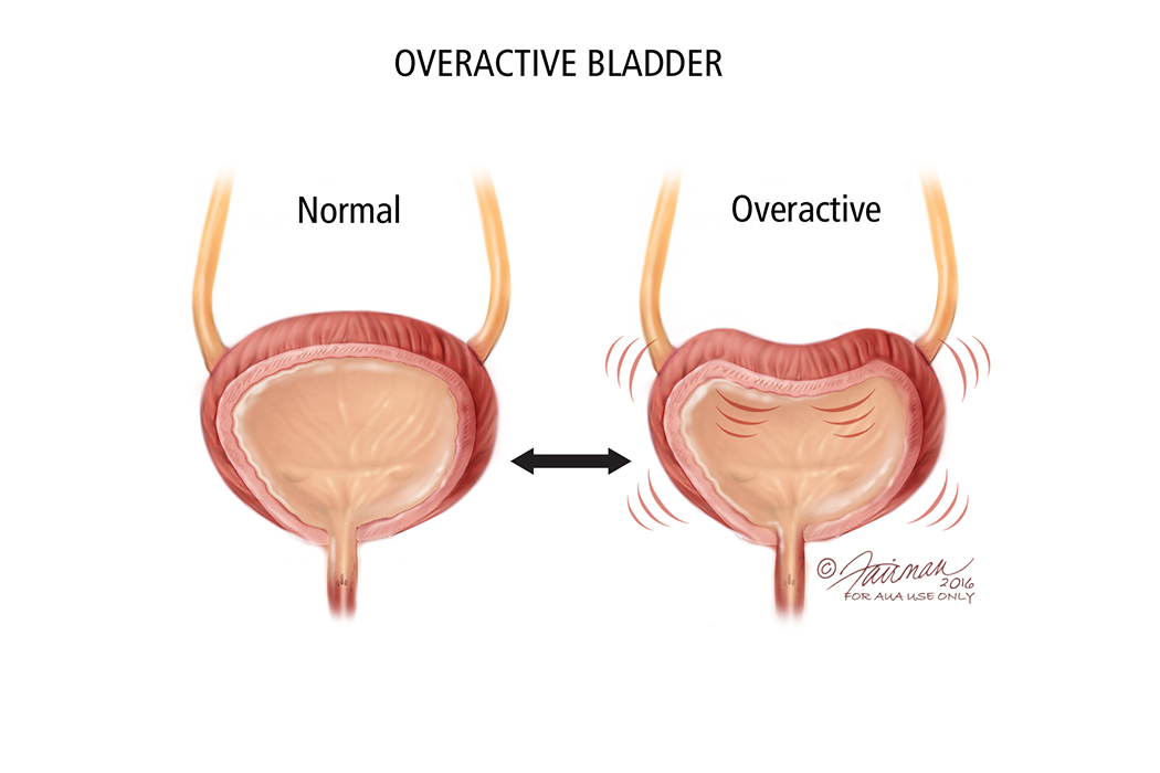 Overactive Bladder (OAB): Symptoms, Diagnosis & Treatment - Urology Care  Foundation