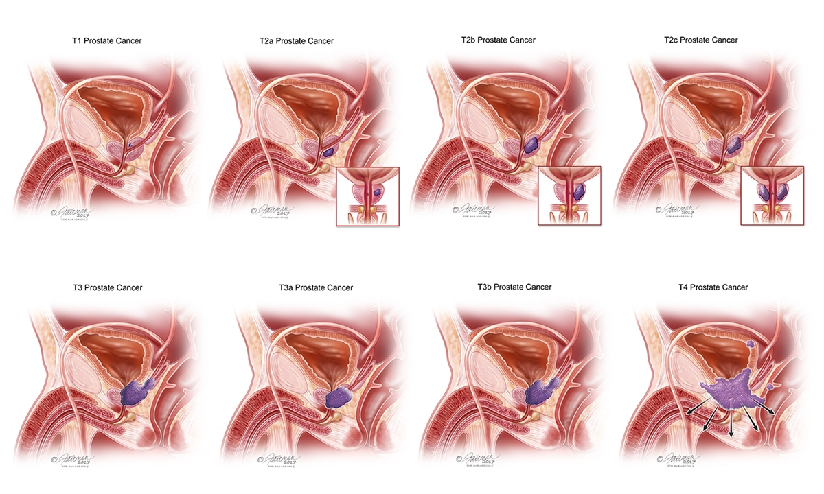 What is t2c prostate cancer