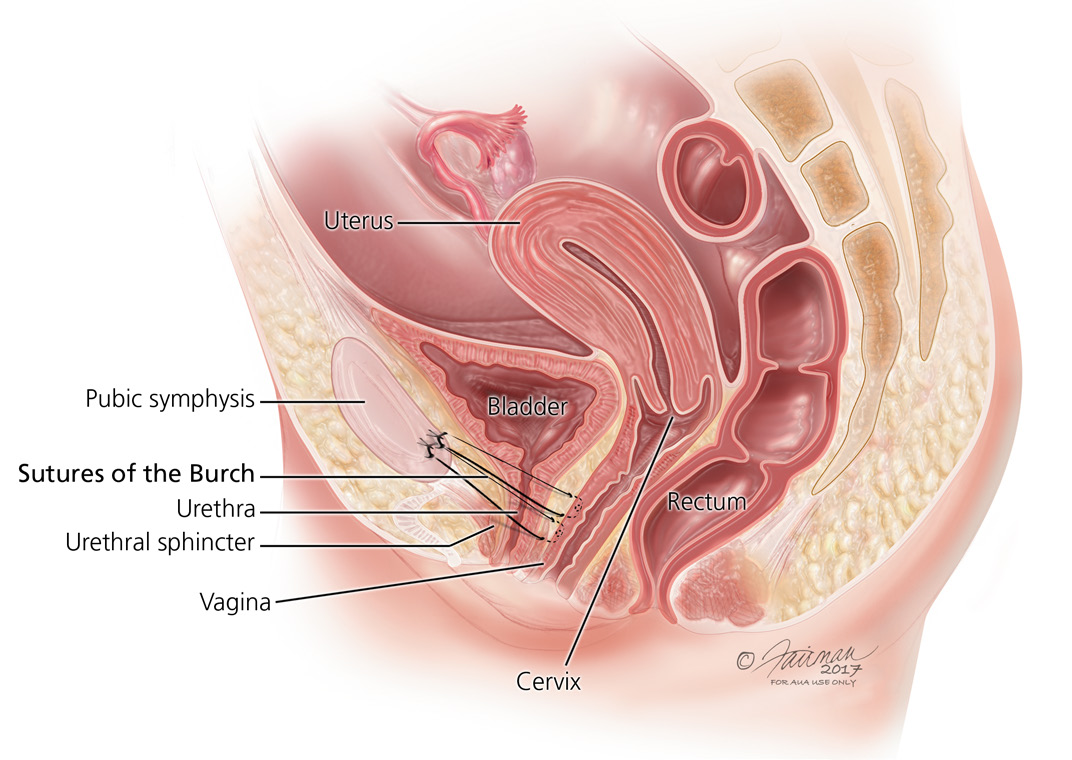 Stress Urinary Incontinence (SUI) Symptoms, Diagnosis and Treatment image