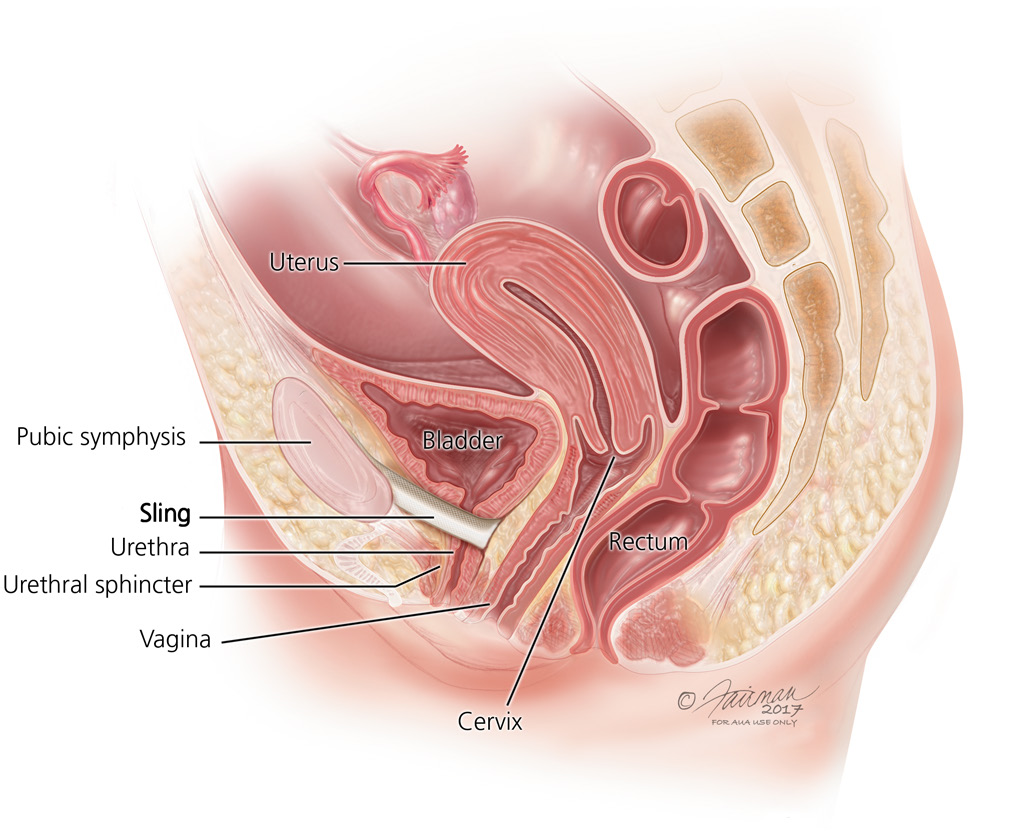 Stress Urinary Incontinence (SUI): Symptoms, Diagnosis & Treatment -  Urology Care Foundation