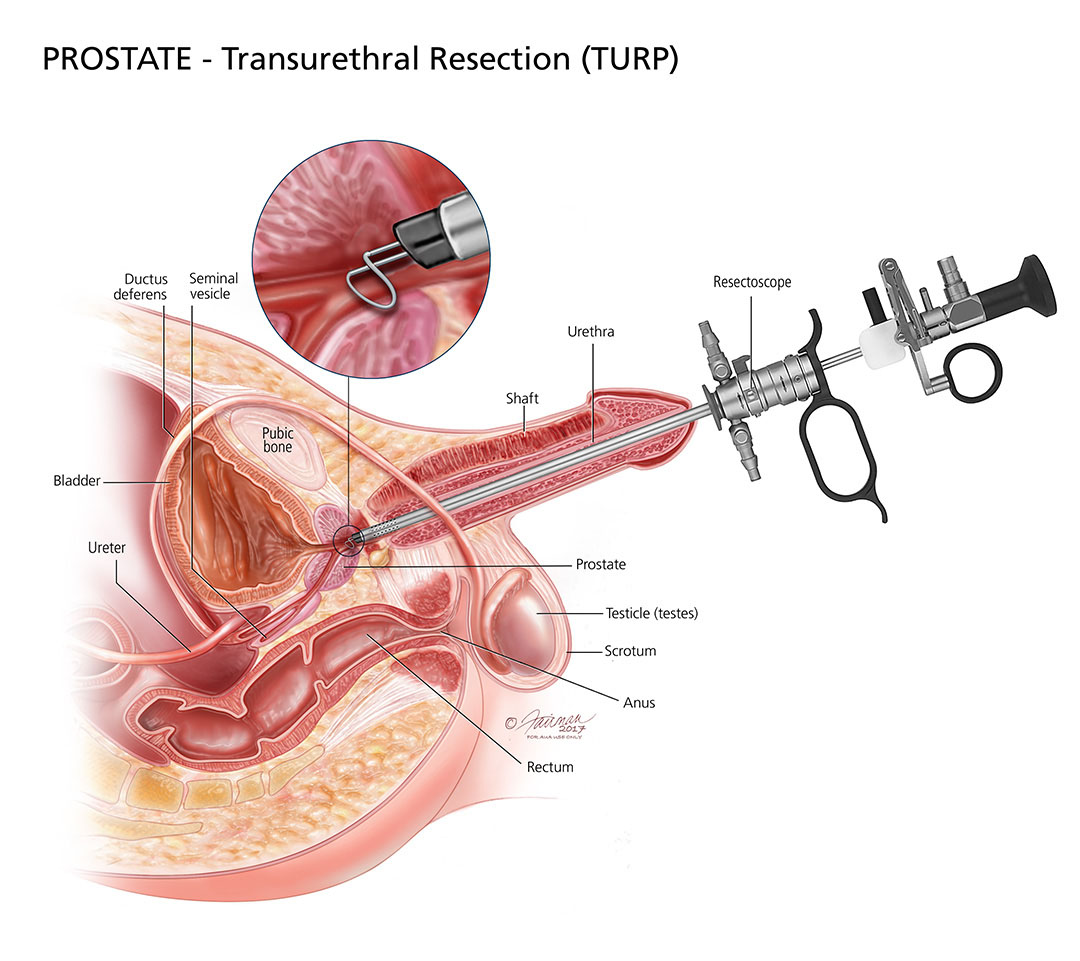 transuretral resection prostat