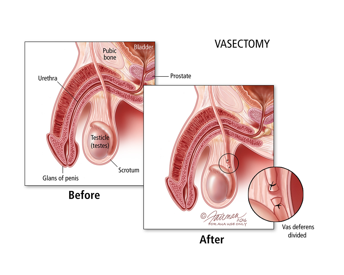 Is vasectomy what Sex After
