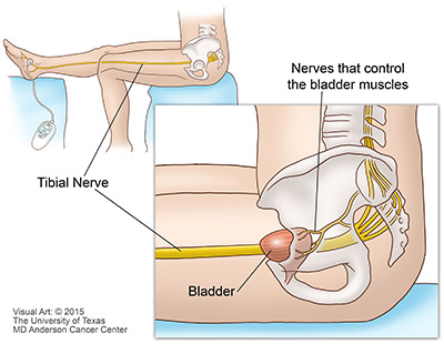 Percutaneous tibial nerve stimulation (PTNS)